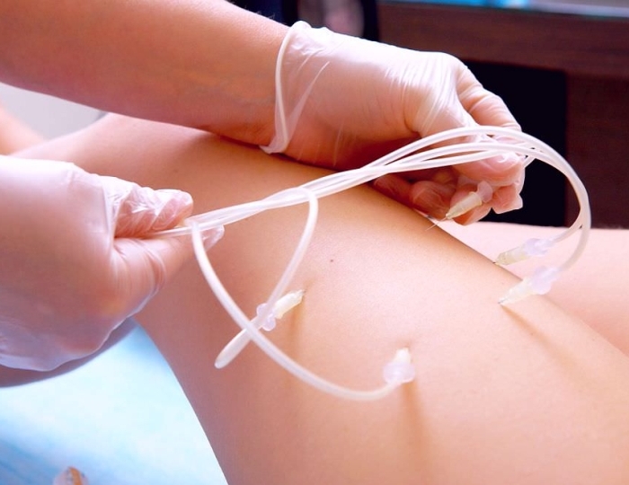 Озонотерапия - Санаторий «ЦВС» Кисловодск